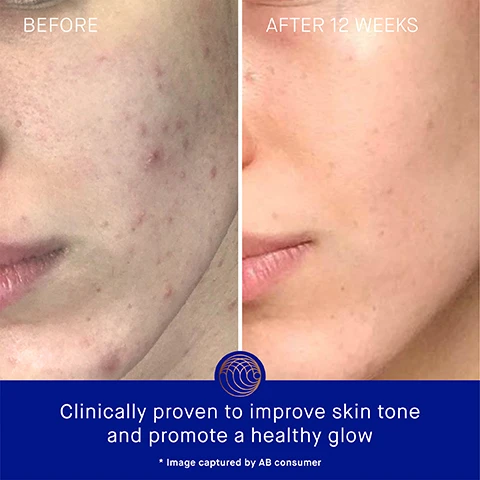 Image 3 - The image shows a side-by-side comparison of a persons face labeled BEFORE on the left, which displays skin with acne and blemishes, and AFTER 12 WEEKS on the right, showcasing clearer skin; visible text includes Clinically proven to improve skin tone and promote a healthy glow and * Image captured by AB consumer.
Image 4 - Image shows a blue and gold skincare product bottle beside text describing its benefits, including claims that skin looks 52% younger, hydration improves by 3.3 times after one hour, and fine lines and wrinkles are reduced by 32%.
Image 5 - A blue skincare bottle with a gold pump is positioned against a copper-colored background, accompanied by four user agreement statements about the products effects on skin hydration, luminosity, and discoloration, along with a small note about the studys basis.
Image 6 - A blue skincare bottle with a gold cap is centered on a white cream swirl, with text highlighting benefits including TFC8® for skin renewal, Vitamin A for reducing fine lines, Vitamin B5 for moisture, and Vitamin C for collagen production and brightening complexion.
Image 7 - Image of two skincare products side by side: on the left, The Cream, a lightweight daily moisturizer, with its benefits and ideal use for combination to oily skin; on the right, The Rich Cream, a luxuriously rich daily moisturizer, with its benefits and ideal use for normal to dry skin.
Image 8 - Image shows a skincare routine with four numbered steps and product descriptions: 1. Cleanse - THE CREAM CLEANSING GEL, 2. Correct & Hydrate - THE SERUM, 3. Nourish & Renew - THE CREAM, THE RICH CREAM OR THE ULTIMATE SOOTHING CREAM, 4. Perfect & Revitalize - THE EYE CREAM.
Image 9 - Four skincare bottles of varying sizes, featuring blue packaging with gold accents, labeled as Augustinus Bader with visible text indicating 15 ml, 30 ml, 50 ml, and 100 ml.
