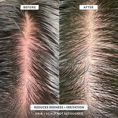Image 1 - Image shows a comparison of a scalp before and after treatment, with the left side labeled Before showing redness and irritation, and the right side labeled After showing reduced redness, accompanied by text that reads REDUCES REDNESS + IRRITATION HAIR + SCALP NOT RETOUCHED.
Image 2 - Side-by-side comparison of a scalp before and after treatment showing improved hair condition with visible text stating BEFORE on the left and AFTER on the right, along with BUSTS FLAKES + REDUCES DANDRUFF and HAIR + SCALP NOT RETOUCHED at the bottom.
Image 3 - Close-up images comparing a scalp before and after treatment, showing flakes and hair strands; visible text reads BEFORE, AFTER, and BUSTS FLAKES HAIR + SCALP NOT RETOUCHED.
Image 4 - Image shows a skincare product with descriptions of its ingredients: powerful AHA/BHA blend, Binchotan charcoal, coconut oil, and tea tree + peppermint oil, along with corresponding imagery of each ingredient.
Image 5 - Image shows three hair care products from Briogeo labeled Scalp Revival alongside fresh mint leaves and charcoal, with text describing their benefits: treat your scalp like you treat your skin, Chemical Exfoliator powerful AHA/BHA blend exfoliates without stripping hair of vital moisture and nutrients, Cooling Hydration soothes scalp + restores moisture after exfoliation, and Physical Exfoliator detoxifies + removes scalp buildup.
Image 6 - A display of various hair care products from Briogeo, including bottles and jars, arranged artistically with a coconut and mint leaves, against a pale blue backdrop, featuring the text scalp care = healthy hair™.
Image 7 - A bottle of Briogeo Scalp Revival shampoo is displayed on a reflective surface with mint leaves and charcoal pieces beside it, and the text reads: CLEAN FORMULA, POWERFUL RESULTS gentle enough for daily use.
Image 8 - A circular graphic promoting 6-free hair care with text indicating it contains no silicones, no harsh sulfates, no parabens, no phthalates, no DEA, and no artificial dyes, along with icons for vegan, cruelty-free, and gluten-free.