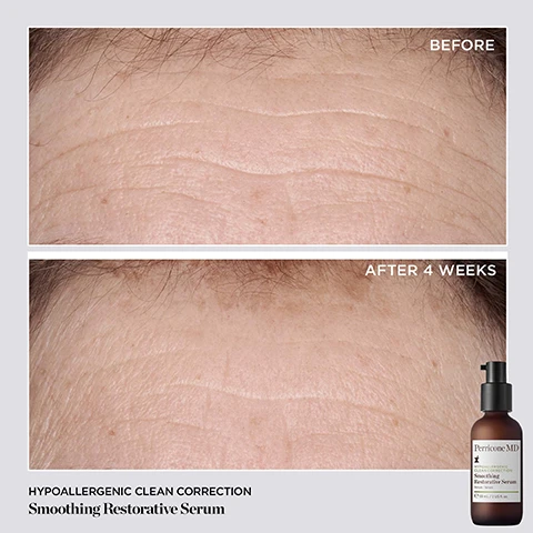 Image 1 - The image shows a comparison of a forehead before and after using a smoothing restorative serum, with noticeable reduction of fine lines and wrinkles after four weeks; visible text includes BEFORE, AFTER 4 WEEKS, HYPOALLERGENIC CLEAN CORRECTION, and Smoothing Restorative Serum.
Image 2 - A brown bottle labeled Perricone MD Smoothing Restorative Serum sits on a light background with cream flowing beside it, showing the following statistics: 92% felt smoother, supple skin, 90% showed significant improvement in skin firmness, texture, radiance, & brightness, and 84% showed a significant reduction in fine lines, with smaller text below noting the source of the claims.
Image 3 - A brown glass serum bottle labeled Perricone MD sits on a textured rock with fresh green basil leaves beside it, featuring text labels for Holy Basil, Niacinamide, and Bakuchiol highlighting their benefits.
Image 4 - A brown bottle of Perricone MD Smoothing Restorative Serum is placed on a textured surface with a flower beside it, featuring three star-ratings and customer testimonials about skin improvement from Maria L., Terri S., and Komal A.
Image 5 - Three skincare products from Perricone MD are displayed on a pale green background, including a bottle of Smoothing Restorative Serum, a jar of Barrier Repair Nourishing Moisturizer, and a small jar labeled Hypoallergenic Clean Correction, with descriptions of their benefits around the items.