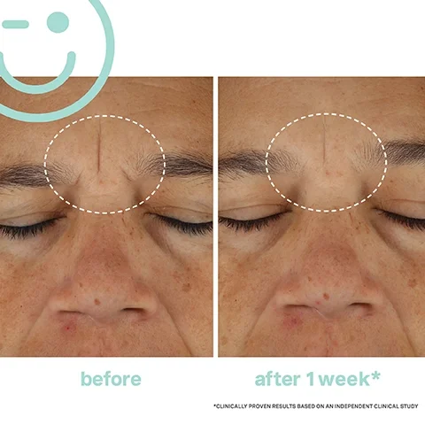 before and after 1 week. clinically proven results based on an independent clinical study.