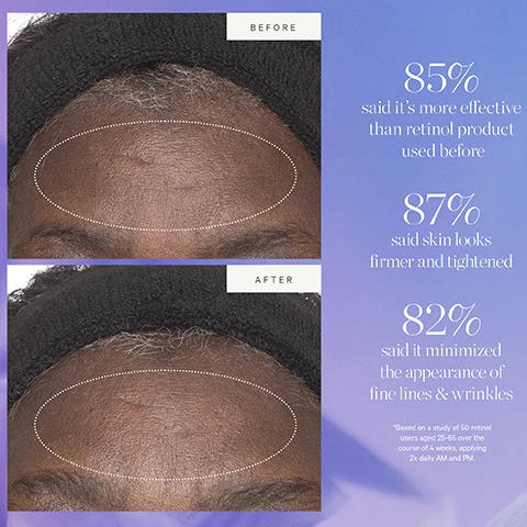 Image 1 - Before and after images showing a persons forehead with reduced fine lines and wrinkles, alongside text that reads BEFORE AFTER 85% said its more effective than retinol product used before 87% said skin looks firmer and tightened 82% said it minimized the appearance of fine lines & wrinkles Based on a study of 50 retinol users aged 25-65 over the course of 4 weeks, applying 2x daily AM and PM. Image 2 - Close-up of dark berries with water droplets and text ACAI PLANT STEM CELL TIGHTEN FIRM SMOOTH. Image 3 - Diagram showing how to recycle a moisturizer jar with a refill pod with text that says KEEP YOUR GLOW WITHOUT THE WASTE HOW TO RECYCLE Plant Stem Cell Retinol Alternative Moisturizer Remove empty pod Rinse out any remaining or excess product Recycle the pod Place new refill pod into glass jar *CONFIRM YOUR LOCAL RECYCLING PROGRAM. Image 4 - Image shows the old and new packaging for KORA Organics Plant Stem Cell Retinol Alternative Moisturizer with the text New Look, Same Formula, KORA ORGANICS, PLANT STEM CELL RETINOL ALTERNATIVE MOISTURIZER, Hydratant à base de cellules souches végétales et dalternatives au rétinol, HYDRATE, TIGHTEN & PLUMP, Hydrater, Tonifier Et Repulper, ALL SKIN TYPES, Tous Types De Peau, TIGHTEN + PLUMP, 50 mL 1.69 fl oz, Please note: Packaging may vary. For a limited time, you may receive either of these packages.